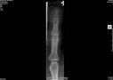 Fin finger